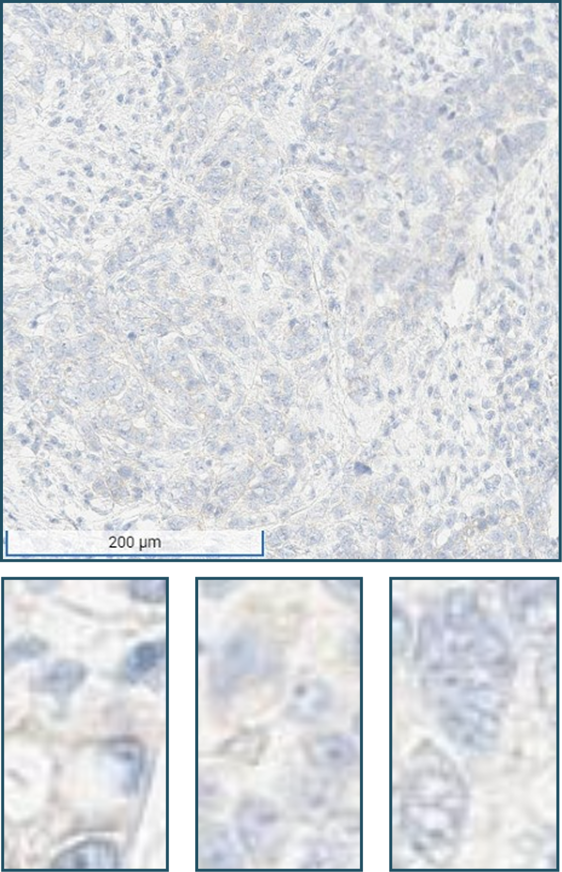alt="(0) no staining FGFR2b protein overexpression evaluation by IHC