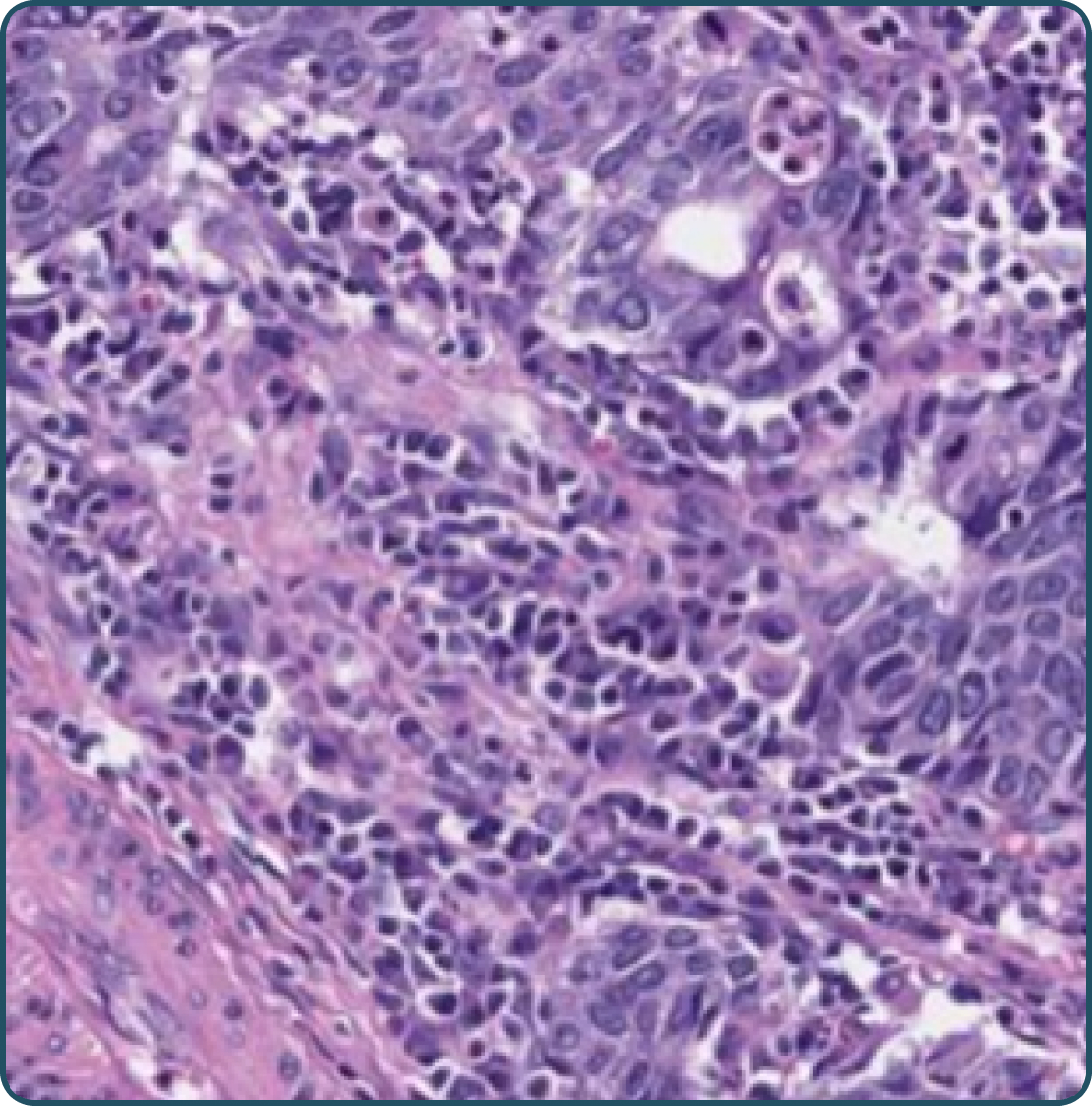 H&E-stained tissue sample of gastric adenocarcinoma